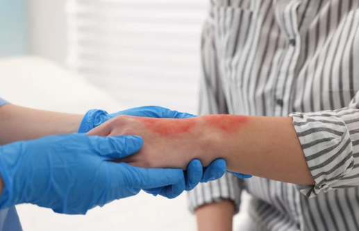 CRMC Trauma Education Series: Initial Assessment and Management of the Burn Patient Banner